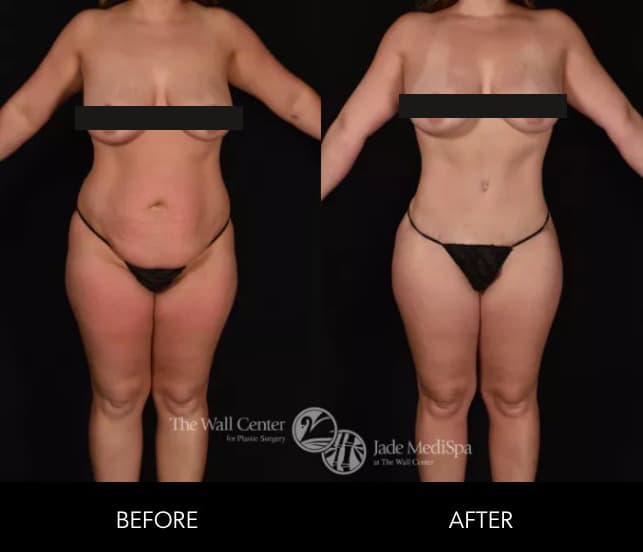 Before and after results