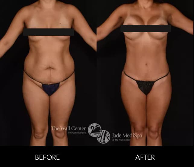 Before and after results