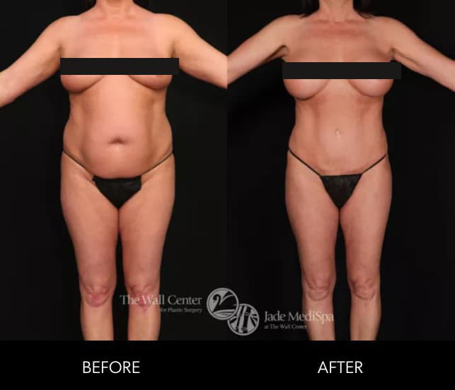 Before and after results