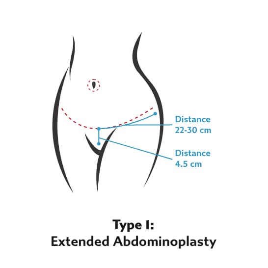 Tummy Tuck Type 1 - Extended Abdominoplasty