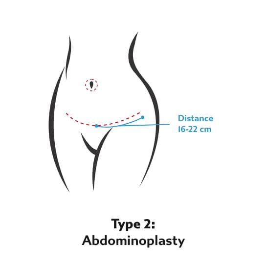 Tummy Tuck Type 2 - Abdominoplasty