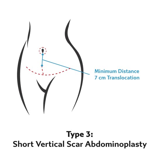 Tummy Tuck Type 3 - Short Vertical Scar Abdominoplasty