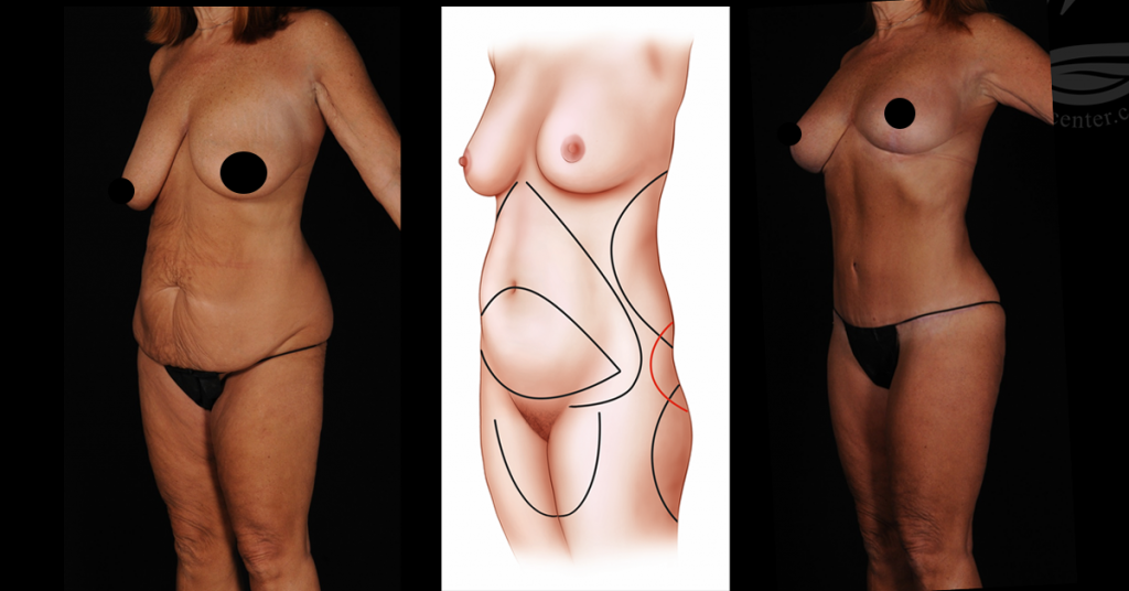 Mommy Makeover before and after photos with illustration in middle showing incision locations