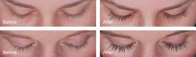 Latisse eyelash enhancement before and after photos