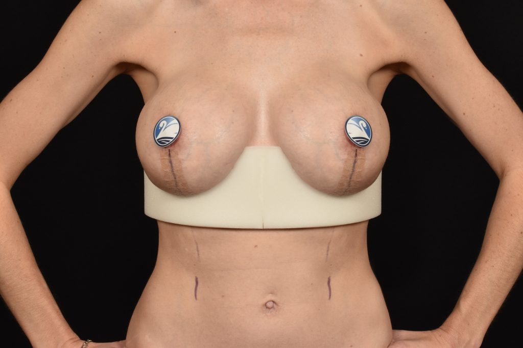 Foam under breasts after breast lift surgery