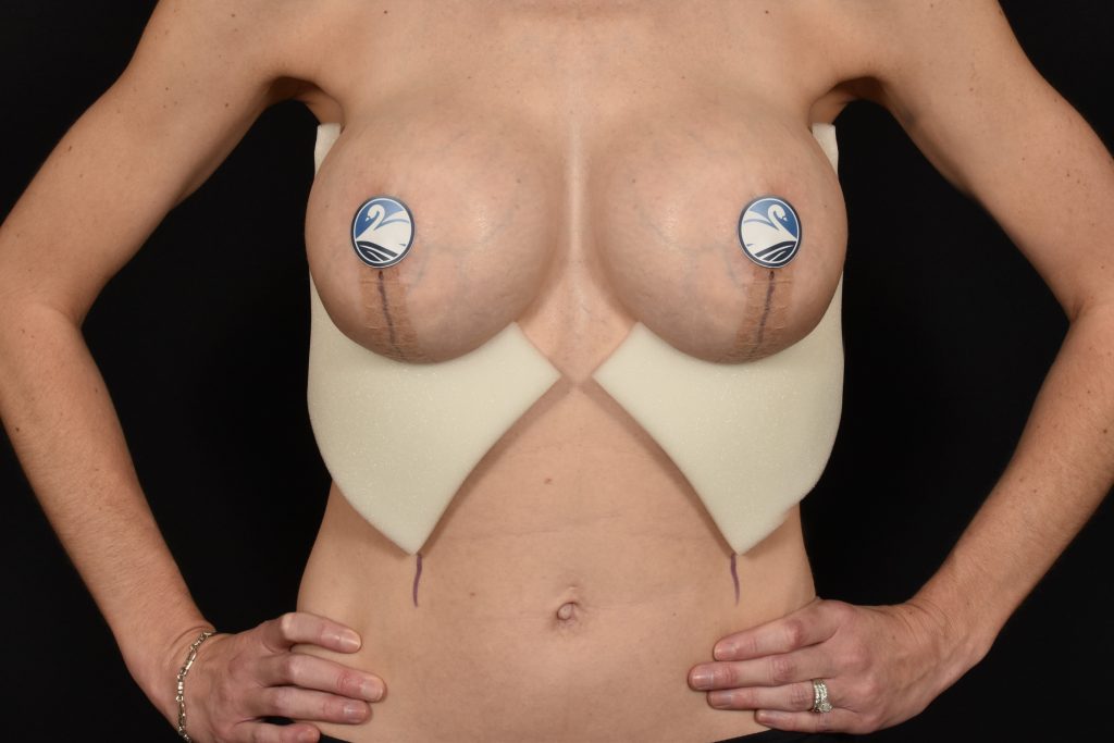Front view of breast lift patient with foam support