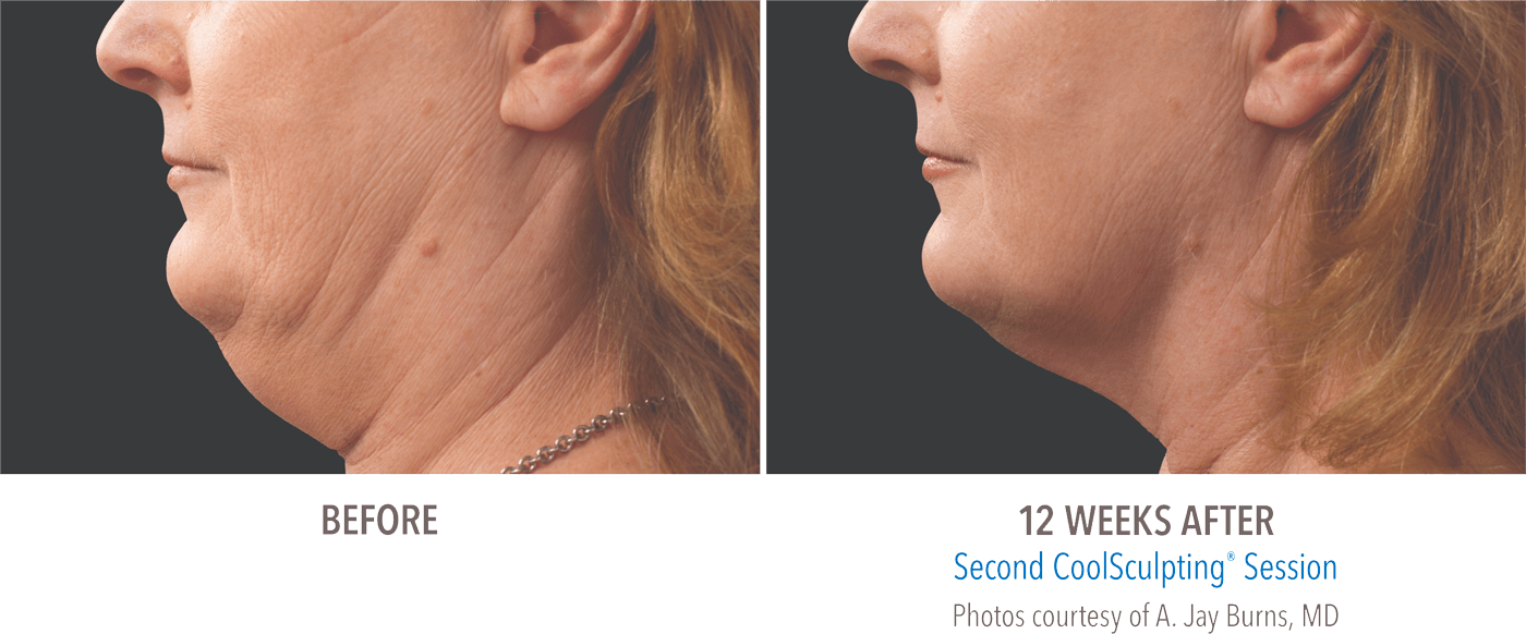 CoolSculpting before and after photos of reduced neck fat