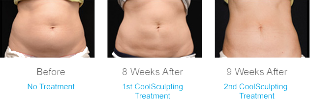 CoolSculpting before and after photos abdomen