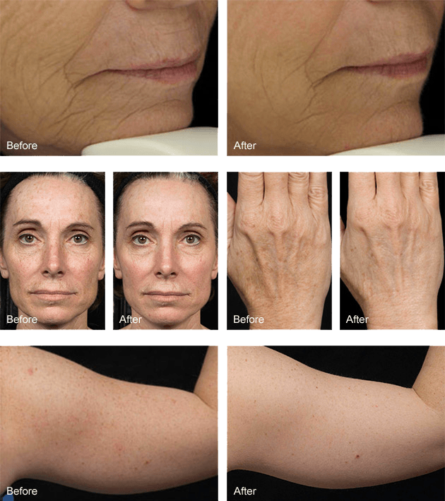 Fraxel laser skin resurfacing before and after photos