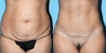 Patient before and after tummy tuck