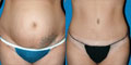 Patient before and after tummy tuck