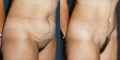 Patient before and after tummy tuck