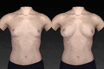 Vectra 3D image showing simulation of breast augmentation before and after