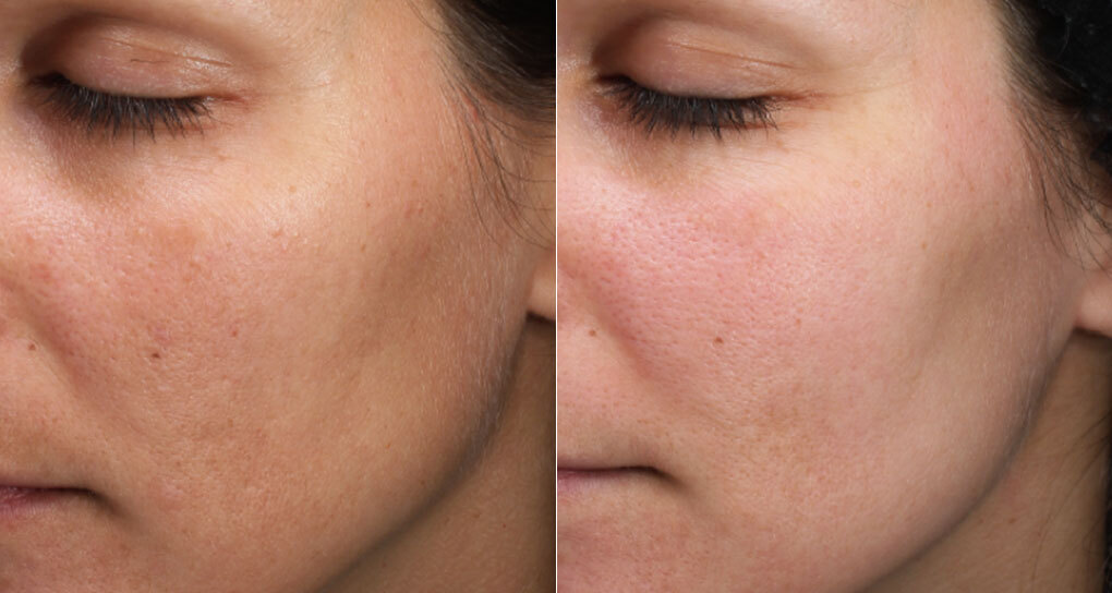 Moxi laser skin rejuvenation before-and-after photos