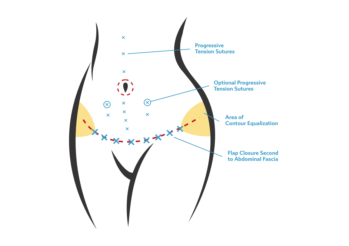 Tummy tuck incision options