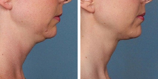 Learn about neck contouring options at The Wall Center for Plastic Surgery, such as Kybella