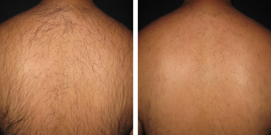 Laser Hair Removal Shreveport