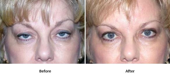 Eyelid surgery before-and-after photos