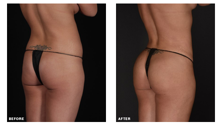 Before and after a Brazilian butt lift procedure performed at The Wall Center by Dr. Simeon Wall Jr.