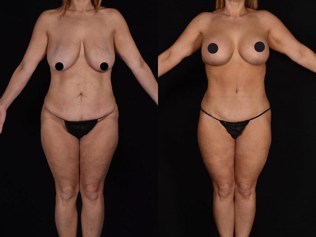 Tummy Tuck Case 369 Before & After VIEW #1 | Shreveport, LA | The Wall Center