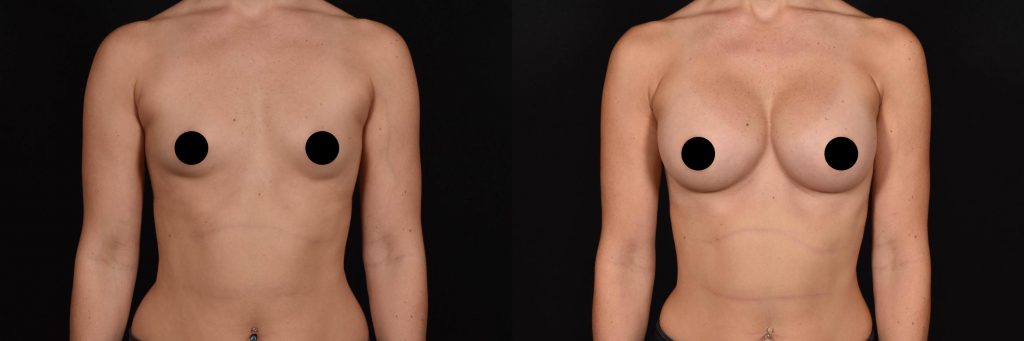 Breast Augmentation Case 800 Before & After VIEW #1 | Shreveport, LA | The Wall Center