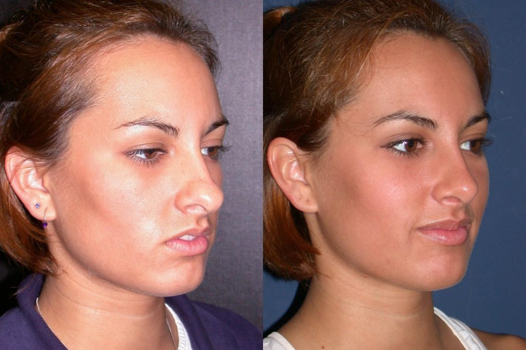 Rhinoplasty Right Oblique Photo, Shreveport, Louisiana, The Wall Center for Plastic Surgery, Case 857