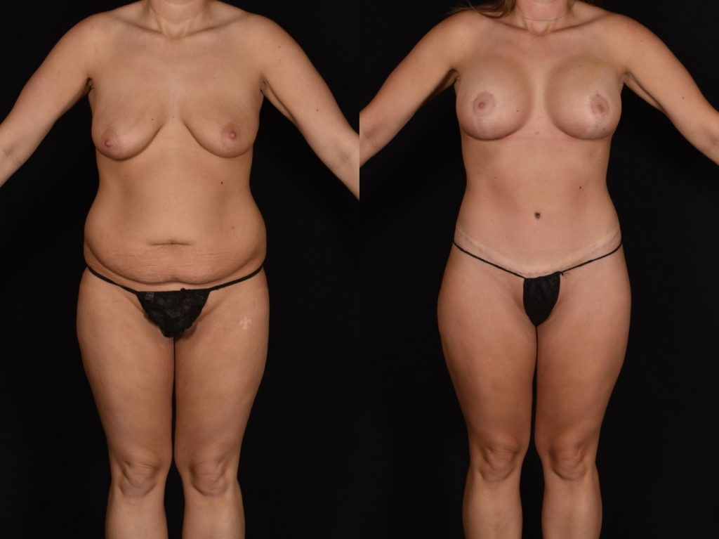 Abdominoplasty with SAFELipo Front Photo, Shreveport, LA, The Wall Center for Plastic Surgery, Case 883