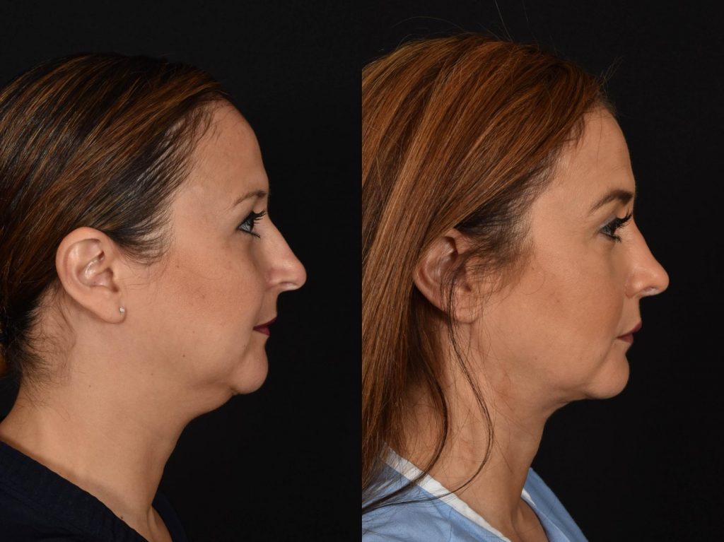 Rhinoplasty & SAFELipo, Right Side, Shreveport, Louisiana, The Wall Center for Plastic Surgery, Case 804