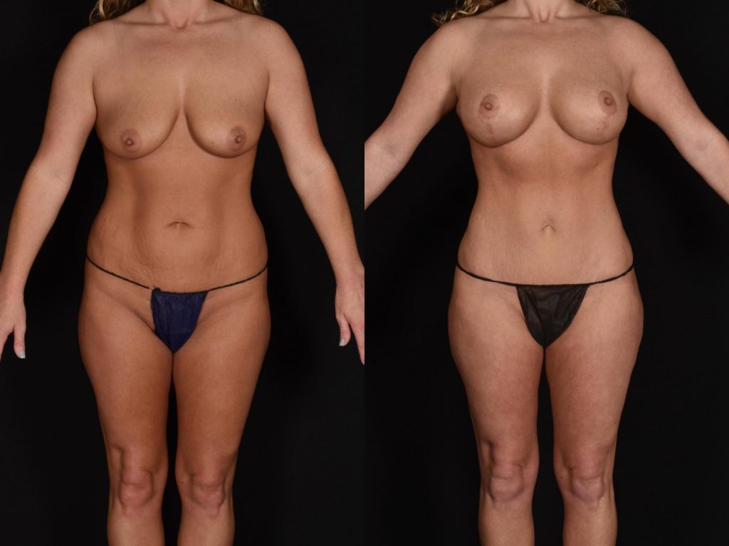 Tummy Tuck Case 677 Before & After VIEW #1 | Shreveport, LA | The Wall Center