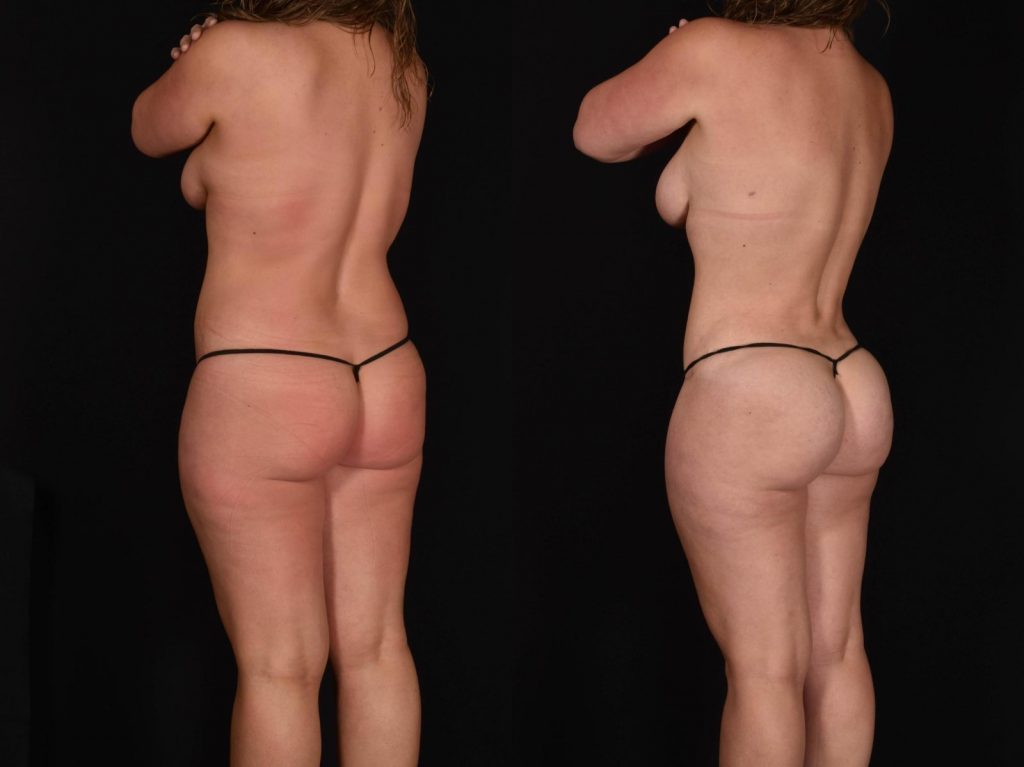 Fat Grafting – Buttocks Case 781 Before & After VIEW #1 | Shreveport, LA | The Wall Center