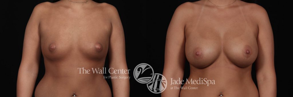 woman's breasts before and after breast augmentation