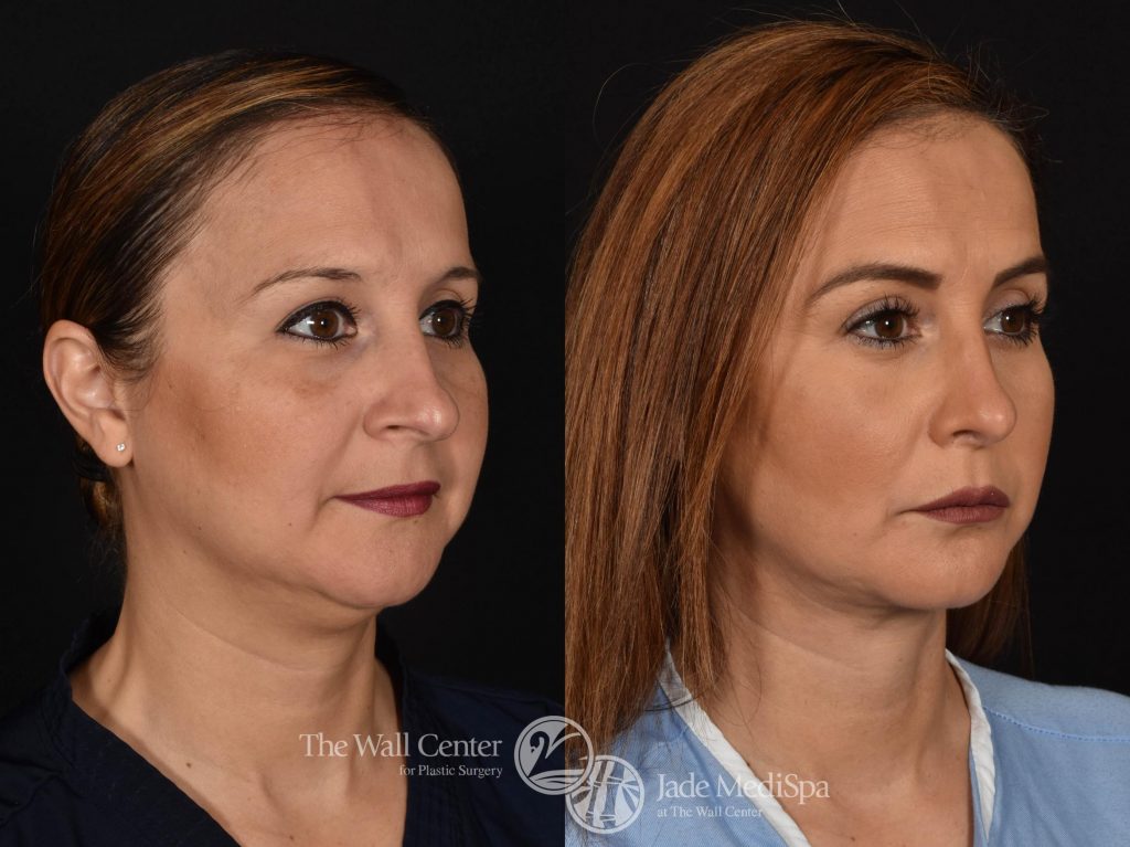 woman's side profile before and after Rhinoplasty & SAFELipo surgery