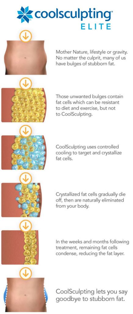 CoolSculpting Flanks (Love Handles) Before & After Photos - Cosmetic -  Ark-La-Tex Dermatology & Medical Spa - Louisiana - A Part of the  Willis-Knighton Physician Network