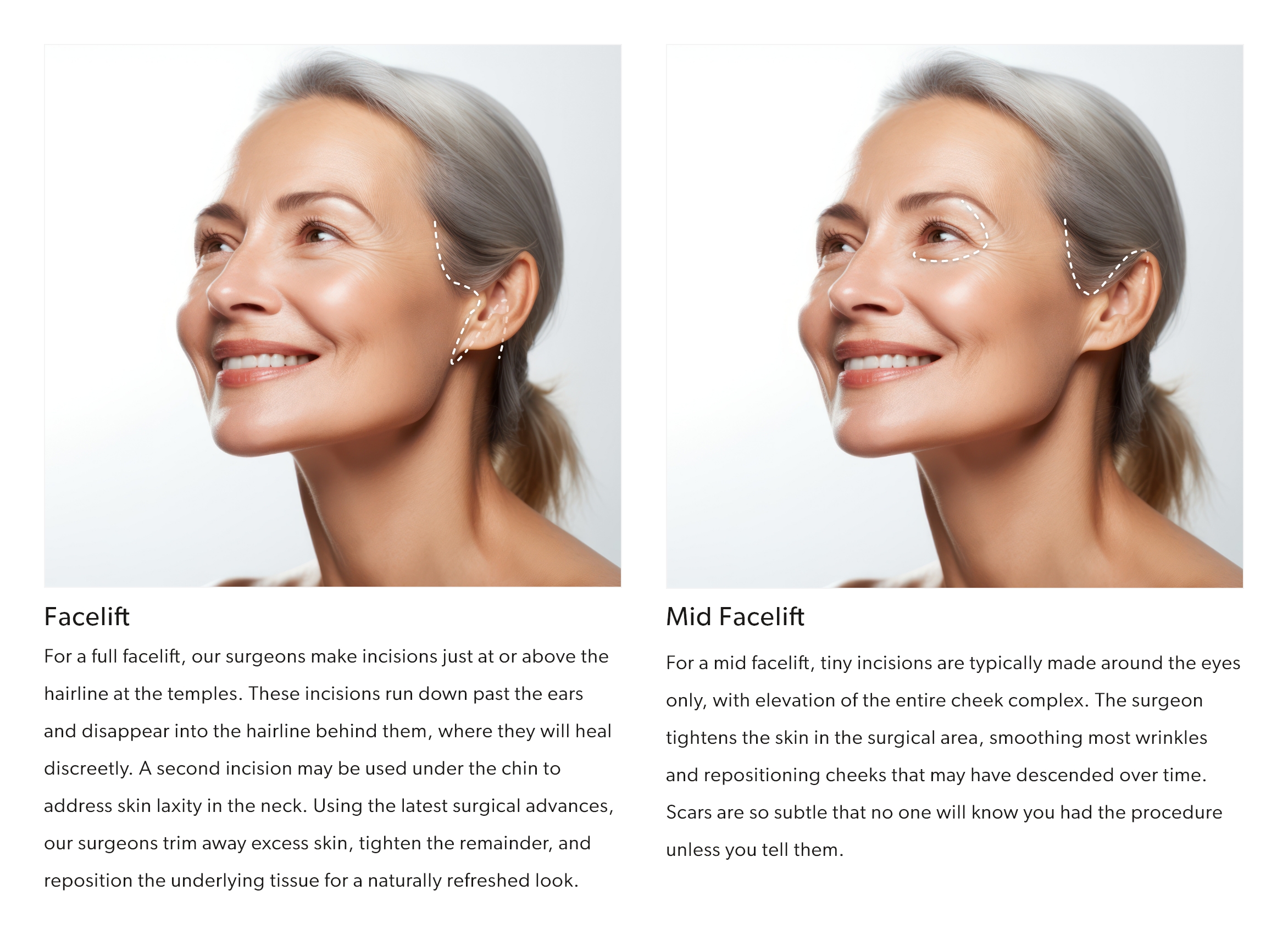 Differences between facelift and mini facelift incisions