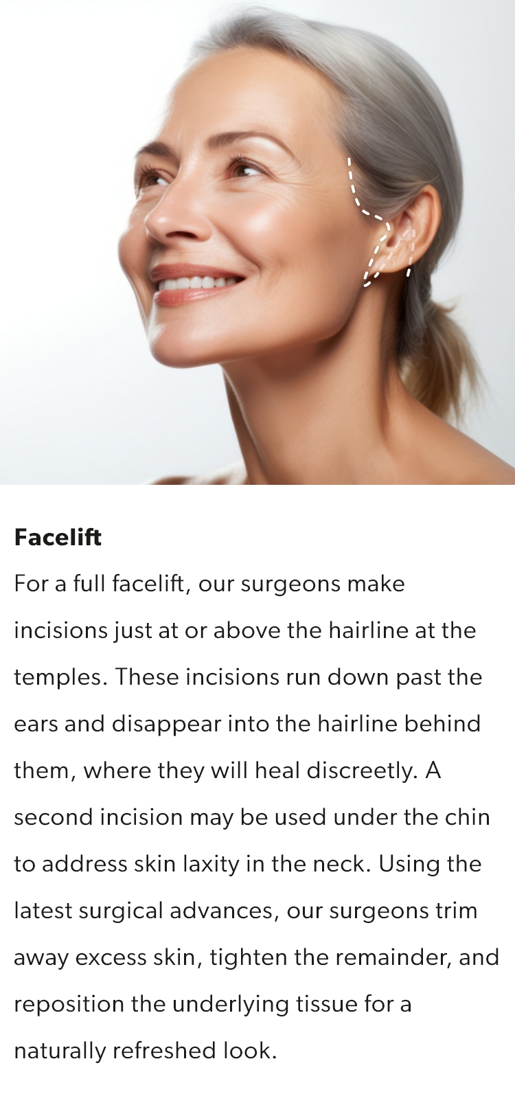 A full facelift will have incisions just at the hairline at the temples