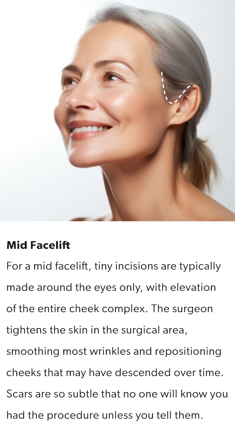 A mid facelift will have incisions around the eyes only