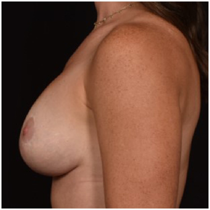 After Footprint Elevating Breast Lift