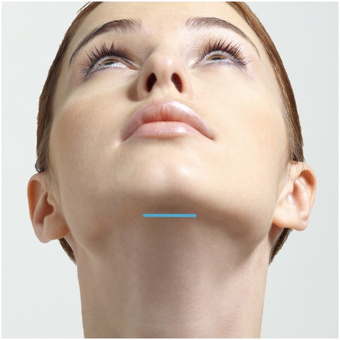 Incision under the chin for deep neck contouring