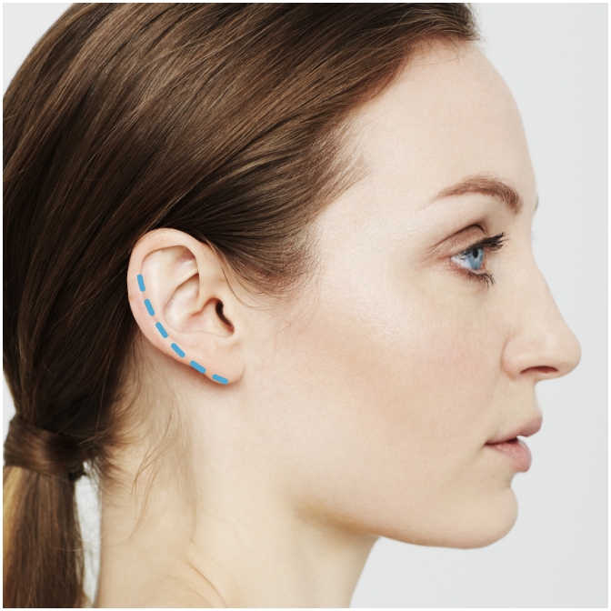 Incision behind the ear for deep neck contouring