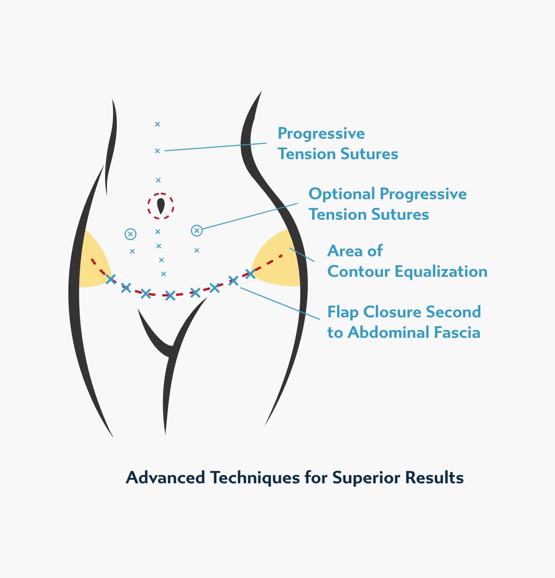Medical illustration of a lower torso showing tummy tuck incision lines, progressive tension sutures, and contour-equalization zones used in advanced abdominoplasty techniques.
