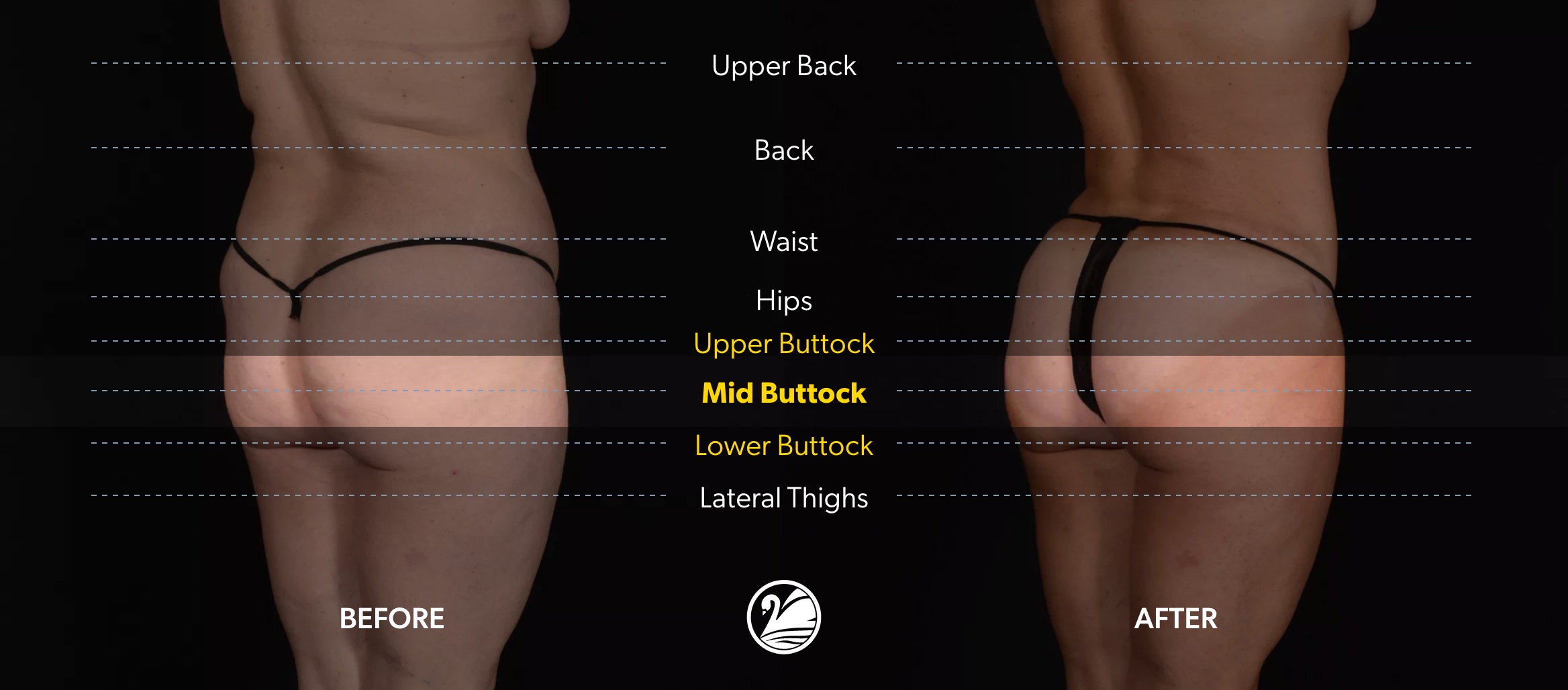 Before-and-after comparison of a person’s lower back, waist, hips, buttocks, and upper thighs with labeled measurement areas, showing changes in buttock shape and contour after treatment