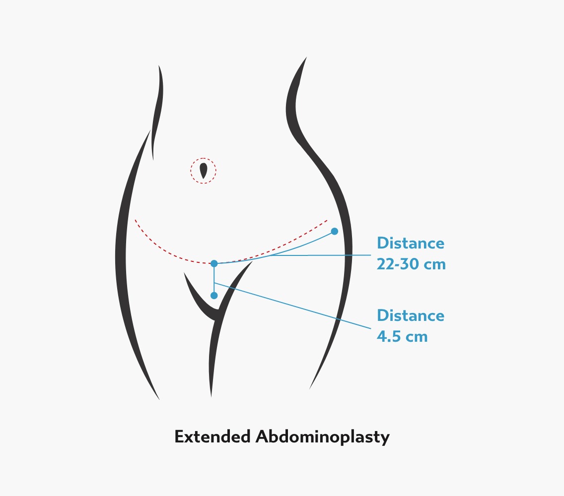Illustration of an extended tummy tuck showing a longer curved incision across the lower abdomen with measurements indicating a wider surgical reach than a standard abdominoplasty.