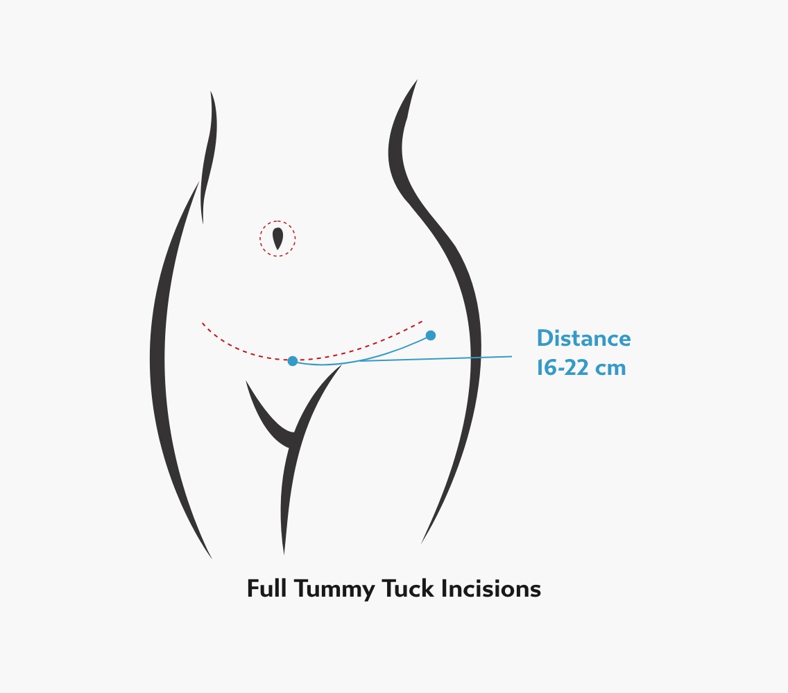 Diagram of a full abdominoplasty showing a hip-to-hip lower abdominal incision and the repositioned belly button with distance markers.