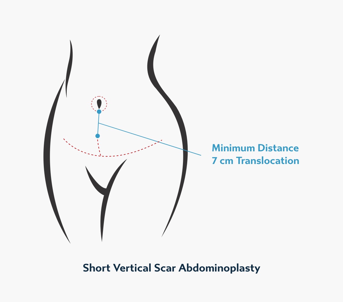 Medical diagram of a short vertical scar tummy tuck showing a vertical incision around the belly button and a curved lower abdominal incision with minimum translocation measurements.