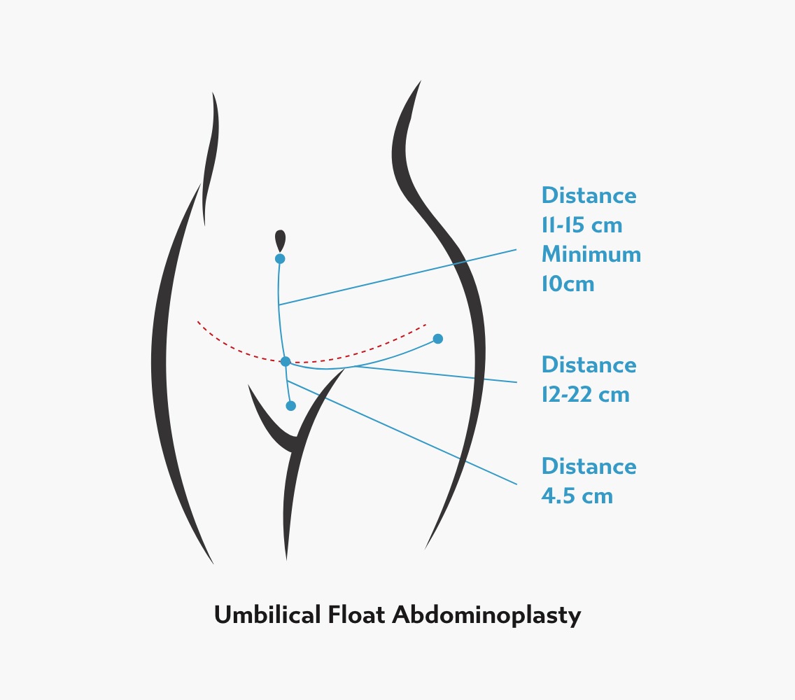 Illustration of an umbilical float tummy tuck showing belly-button repositioning without external scarring and multiple incision distances across the lower abdomen.