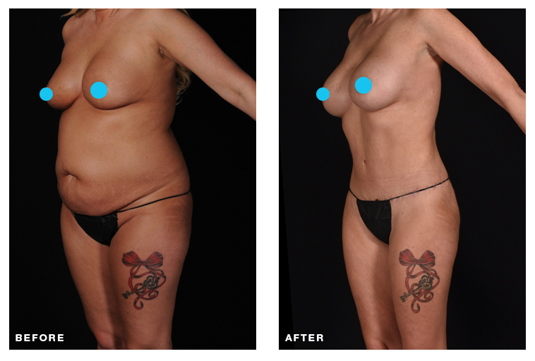 Before and after plastic surgery