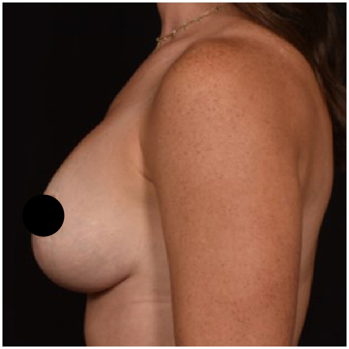 After Footprint Elevating Breast Lift