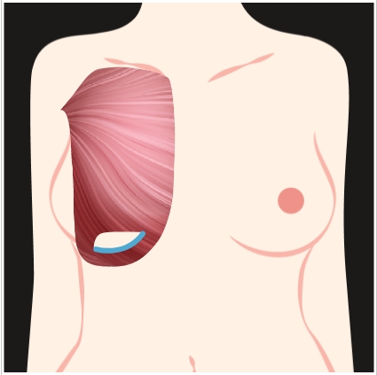 Muscle Released Along Inner Middle Breast Fold