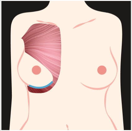 Muscle Released Along Breast Fold