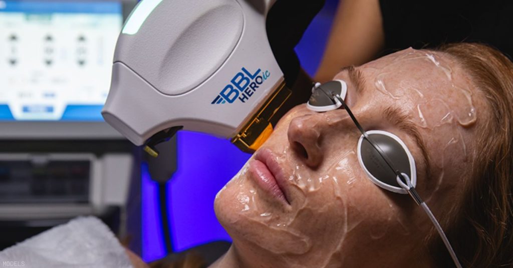 Model image of a BBL Hero treatment
